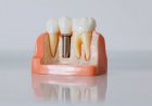 Ontario Dental and Denture Benefits for Seniors